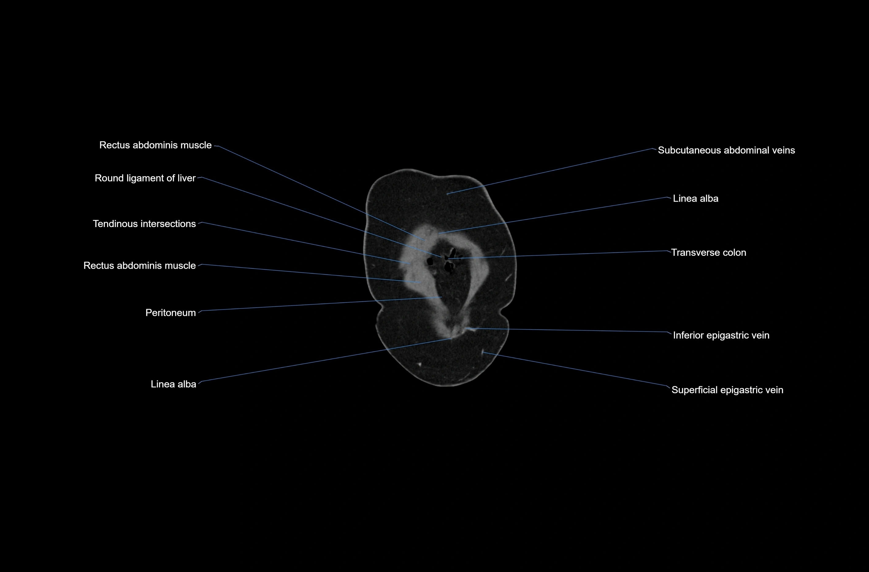 CT abdomen coronal cross sectional anatomy labelled radiology image-00005.webp